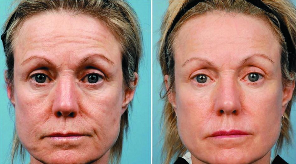 Плазмолифтинг отзывы фото до и после лицо. Плазменный лифтинг лица. Плазмотерапия лица. Плазмолифтинг лица до и после.